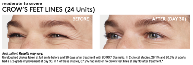 Botox result at Renew Wellness & Aesthetics in Oklahoma City, OK