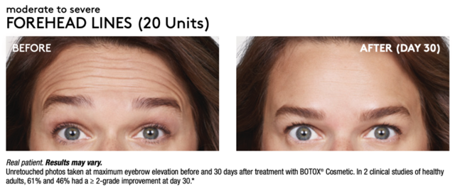 Botox result at Renew Wellness & Aesthetics in Oklahoma City, OK