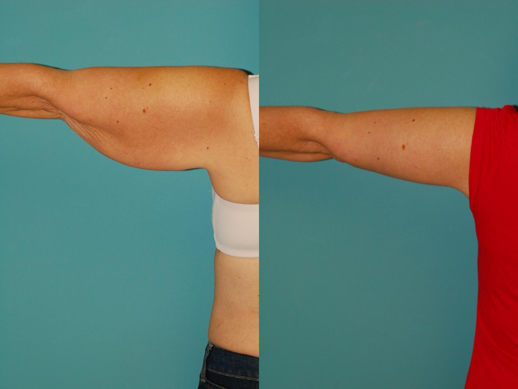 Sinno Center for Plastic Surgery (Fady A. Sinno, MD) arm lift result — Ellicott City, MD
