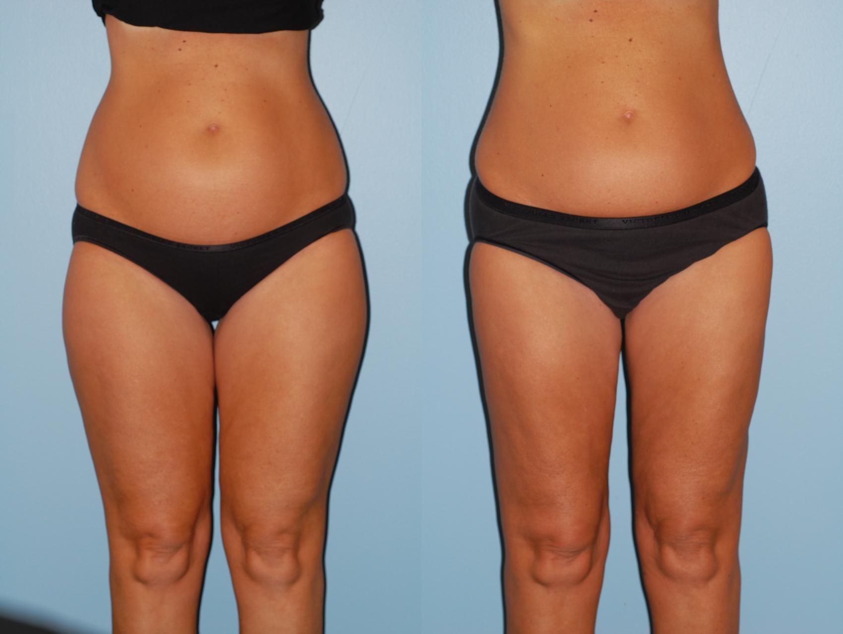 Sinno Center for Plastic Surgery (Fady A. Sinno, MD) liposuction result — Ellicott City, MD