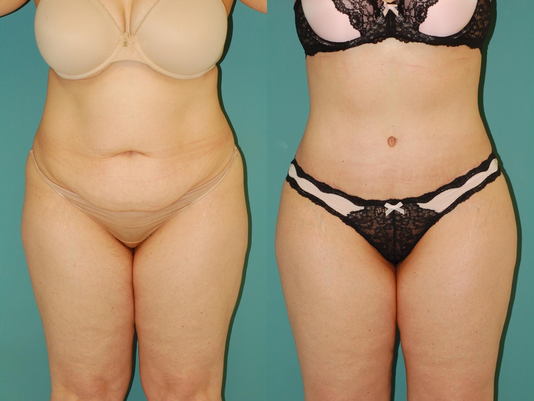 Sinno Center for Plastic Surgery (Fady A. Sinno, MD) tummy tuck result — Ellicott City, MD