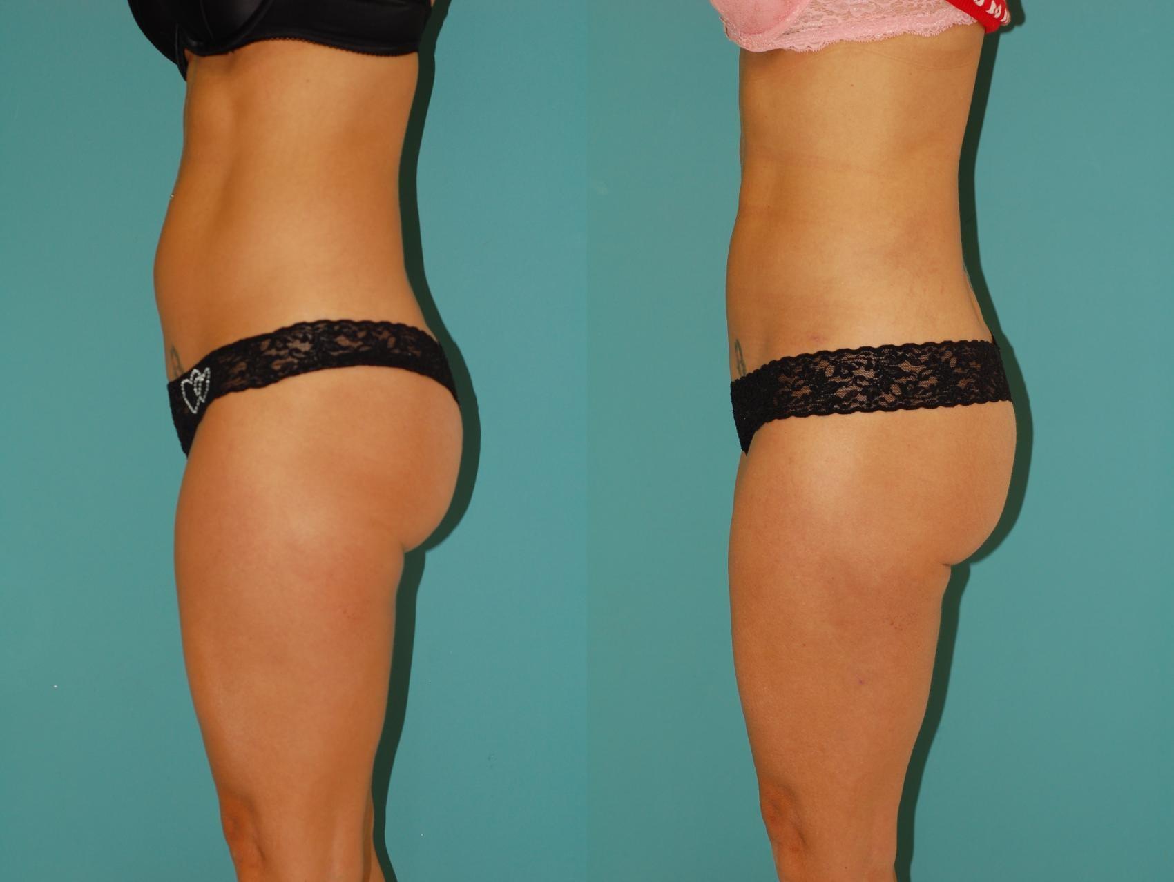 Sinno Center for Plastic Surgery (Fady A. Sinno, MD) liposuction result — Ellicott City, MD