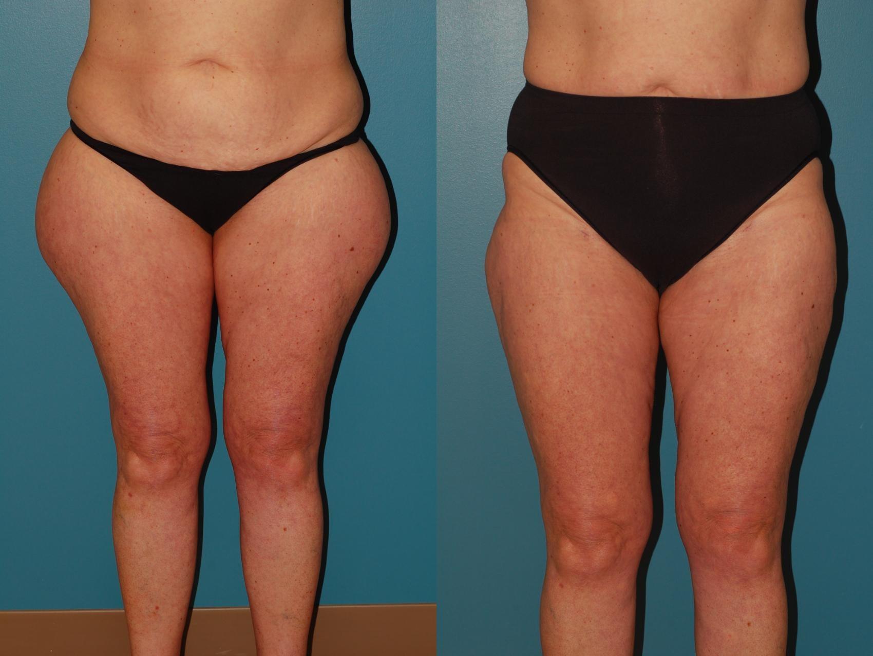 Sinno Center for Plastic Surgery (Fady A. Sinno, MD) liposuction result — Ellicott City, MD