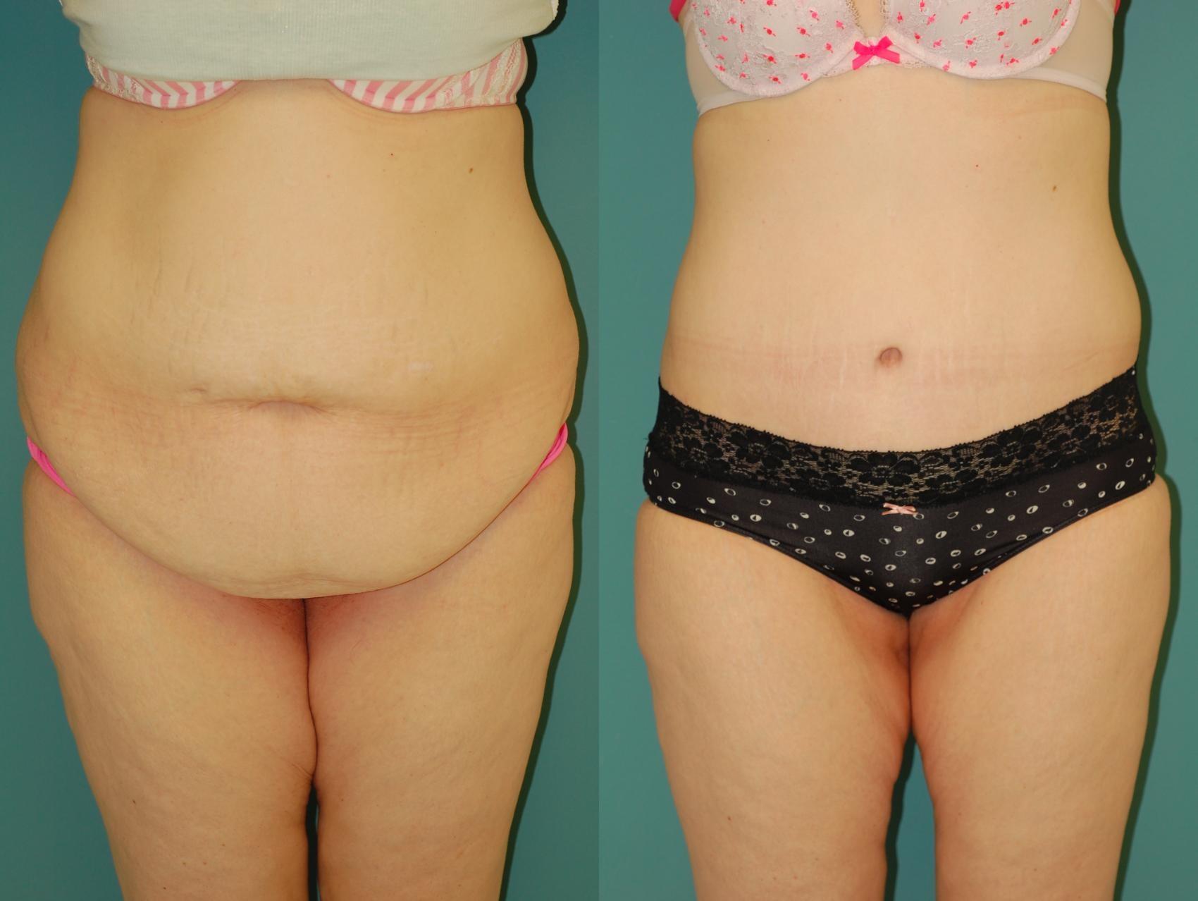 Sinno Center for Plastic Surgery (Fady A. Sinno, MD) tummy tuck result — Ellicott City, MD