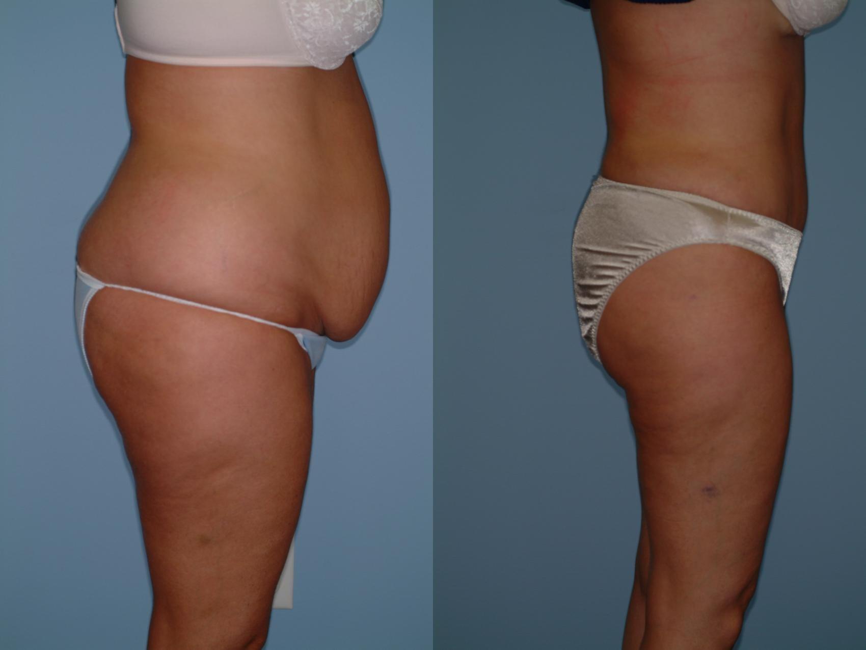 Sinno Center for Plastic Surgery (Fady A. Sinno, MD) tummy tuck result — Ellicott City, MD