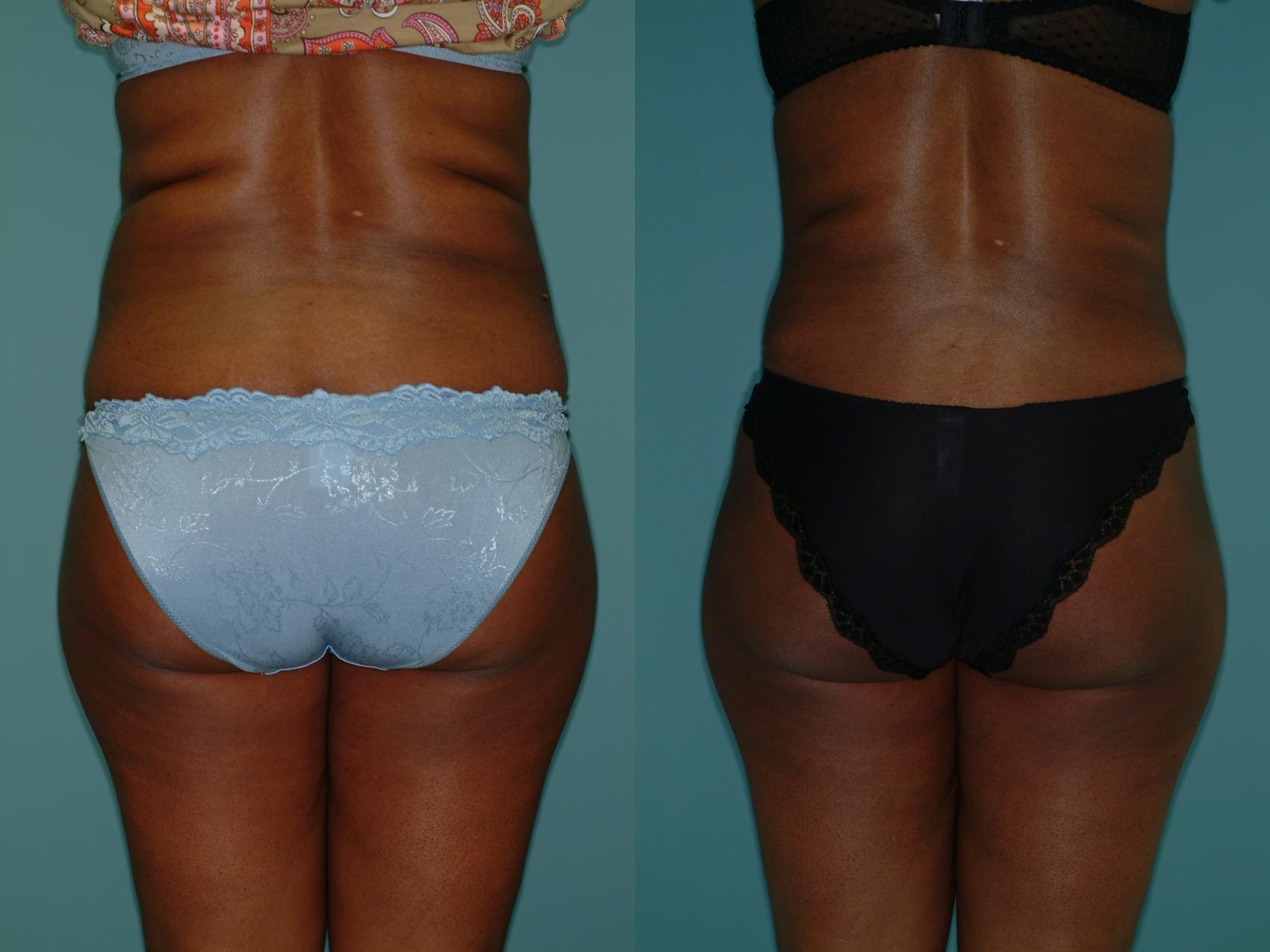 Sinno Center for Plastic Surgery (Fady A. Sinno, MD) liposuction result — Ellicott City, MD