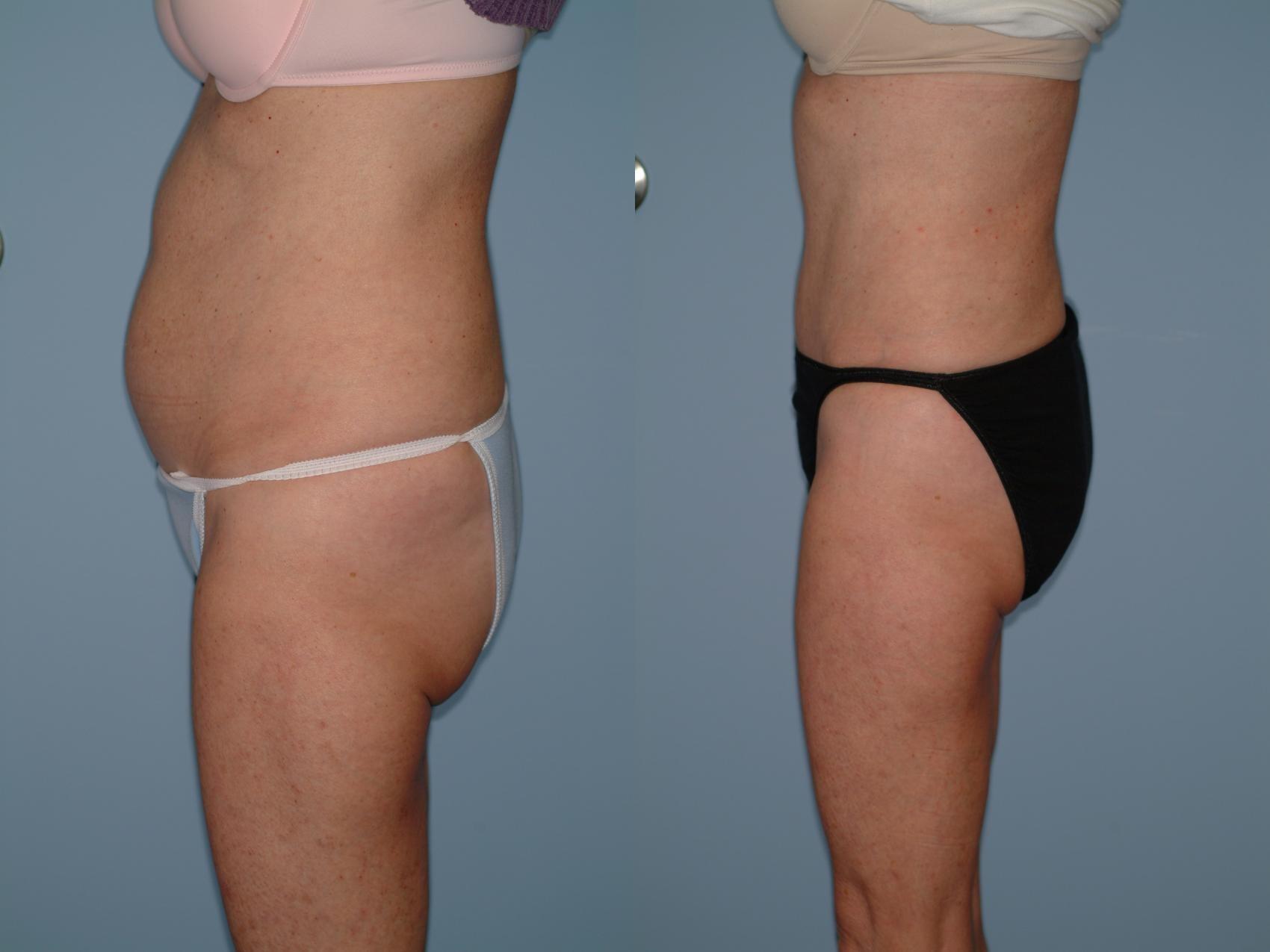 Sinno Center for Plastic Surgery (Fady A. Sinno, MD) liposuction result — Ellicott City, MD
