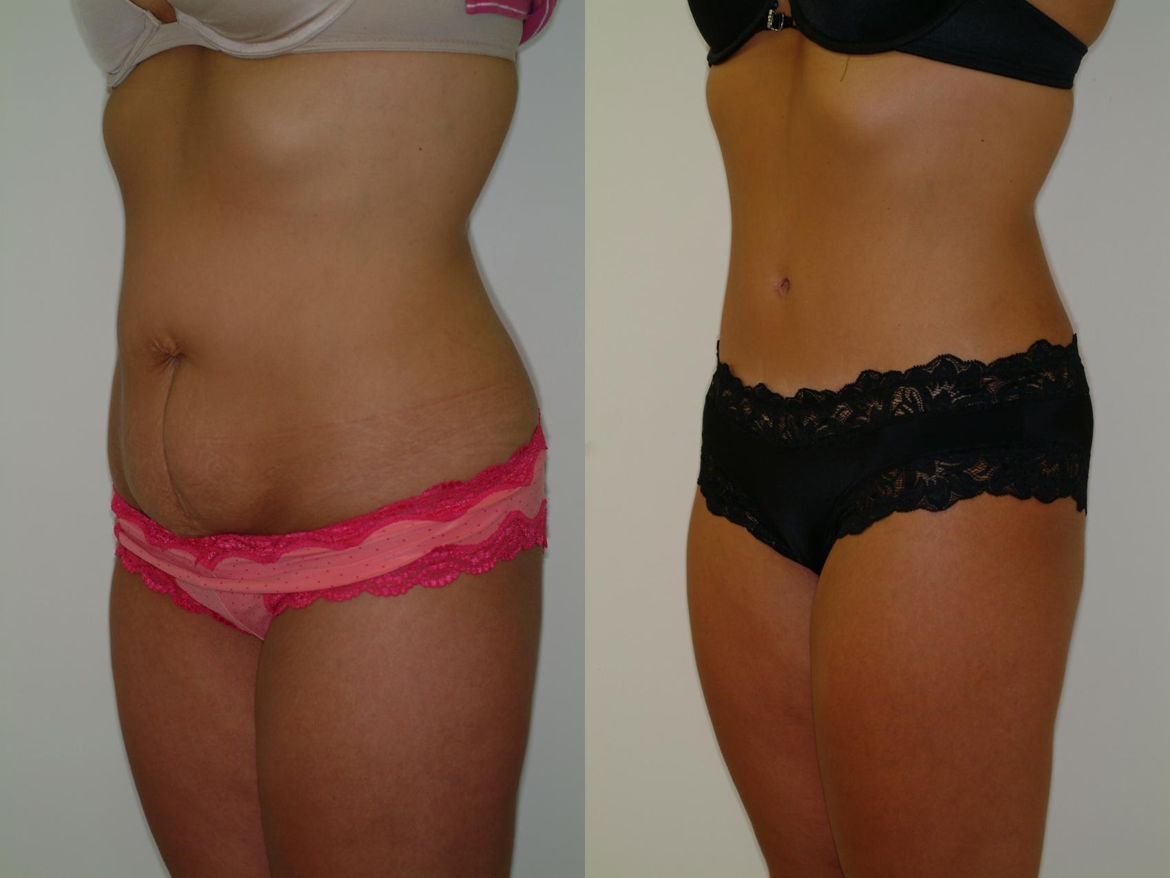 Sinno Center for Plastic Surgery (Fady A. Sinno, MD) tummy tuck result — Ellicott City, MD