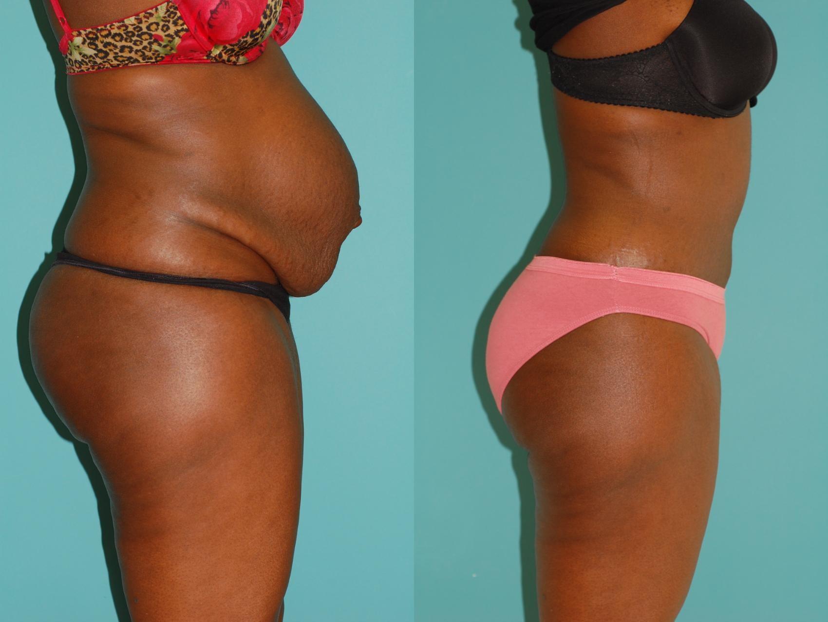 Sinno Center for Plastic Surgery (Fady A. Sinno, MD) tummy tuck result — Ellicott City, MD