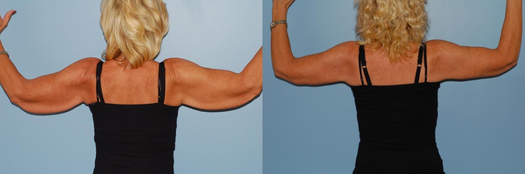 Sinno Center for Plastic Surgery (Fady A. Sinno, MD) arm lift result — Ellicott City, MD
