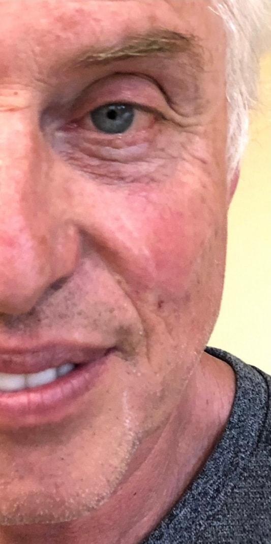 Village Plastic Surgery (Pedy Ganchi, MD) under-eye filler after — Ridgewood, NJ
