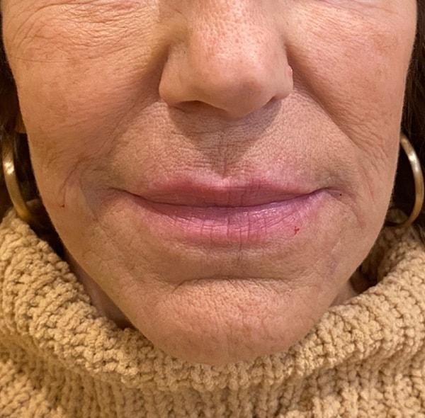 Village Plastic Surgery (Pedy Ganchi, MD) lip filler after — Ridgewood, NJ