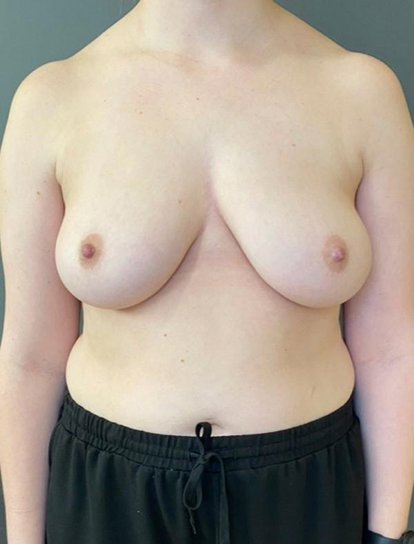 Village Plastic Surgery (Pedy Ganchi, MD) breast augmentation revision after — Ridgewood, NJ