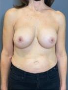 Village Plastic Surgery (Pedy Ganchi, MD) breast augmentation revision after — Ridgewood, NJ