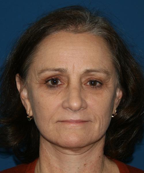 North Coast Plastic Surgery facelift after — Oceanside, CA