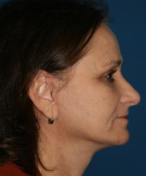 North Coast Plastic Surgery facelift after — Oceanside, CA