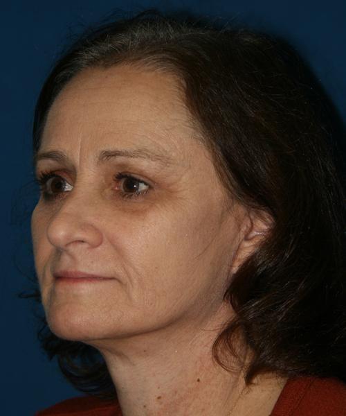 North Coast Plastic Surgery facelift after — Oceanside, CA