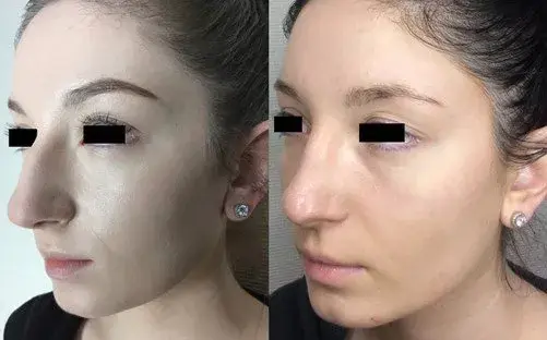 Masri Clinic for Laser and Cosmetic Surgery rhinoplasty result — Dearborn, MI