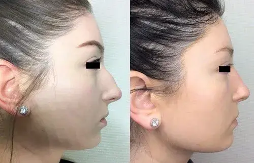 Functional Rhinoplasty result at Masri Clinic for Laser and Cosmetic Surgery in Dearborn, MI