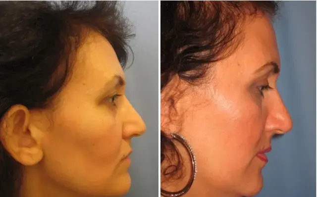 Functional Rhinoplasty result at Masri Clinic for Laser and Cosmetic Surgery in Dearborn, MI