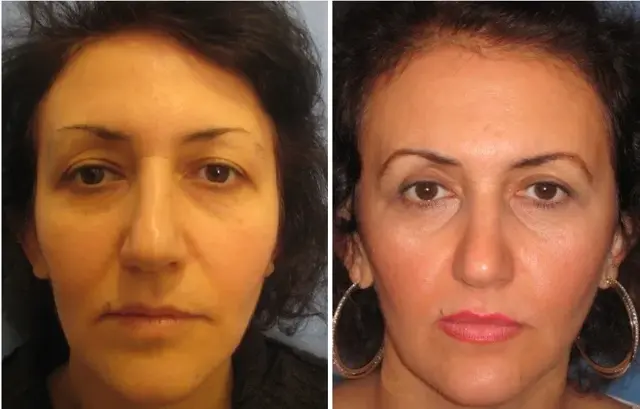 Functional Rhinoplasty result at Masri Clinic for Laser and Cosmetic Surgery in Dearborn, MI