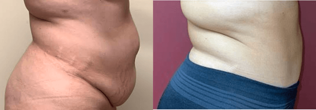 Masri Clinic for Laser and Cosmetic Surgery tummy tuck result — Dearborn, MI