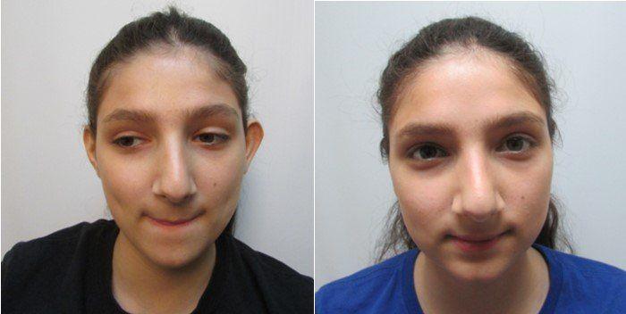 Masri Clinic for Laser and Cosmetic Surgery otoplasty result — Dearborn, MI
