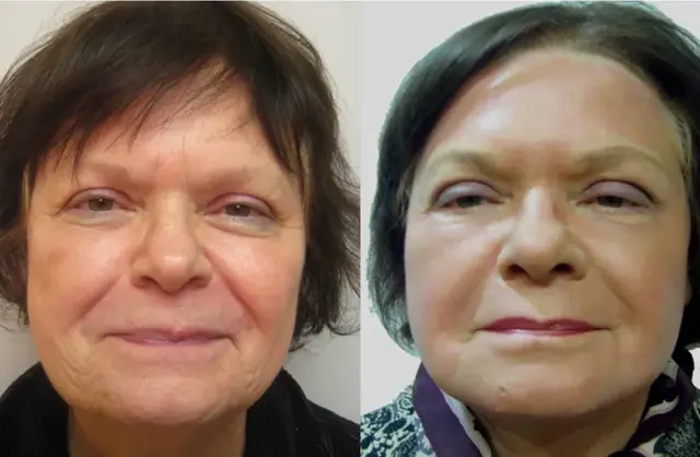Laser Skin Resurfacing result at Masri Clinic for Laser and Cosmetic Surgery in Dearborn, MI