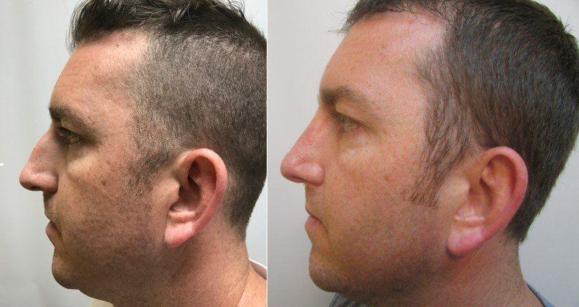 Masri Clinic for Laser and Cosmetic Surgery rhinoplasty result — Dearborn, MI