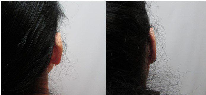 Masri Clinic for Laser and Cosmetic Surgery otoplasty result — Dearborn, MI
