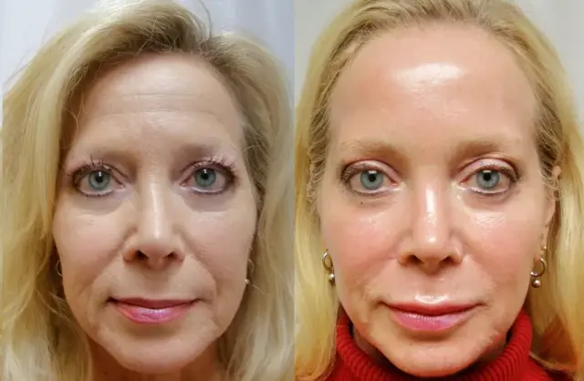 Laser Skin Resurfacing result at Masri Clinic for Laser and Cosmetic Surgery in Dearborn, MI