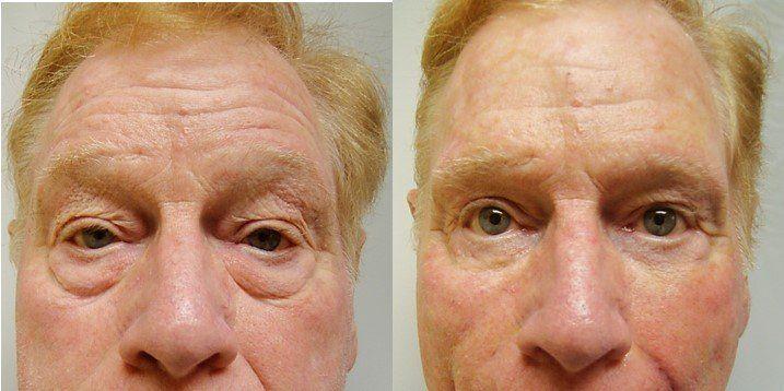 Masri Clinic for Laser and Cosmetic Surgery blepharoplasty result — Dearborn, MI