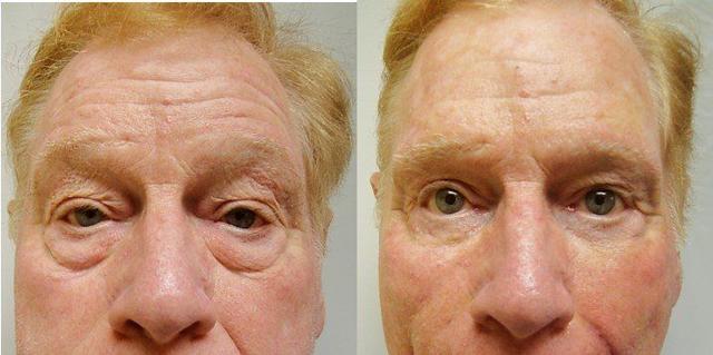 Blepharoplasty result at Masri Clinic for Laser and Cosmetic Surgery in Dearborn, MI