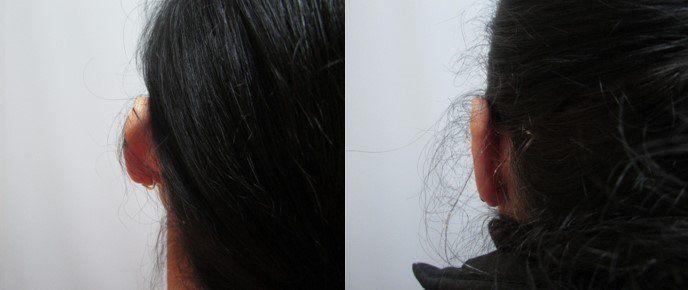 Masri Clinic for Laser and Cosmetic Surgery otoplasty result — Dearborn, MI
