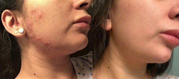 Morpheus8 result at Masri Clinic for Laser and Cosmetic Surgery in Dearborn, MI