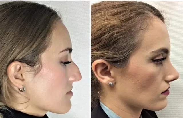 Functional Rhinoplasty result at Masri Clinic for Laser and Cosmetic Surgery in Dearborn, MI