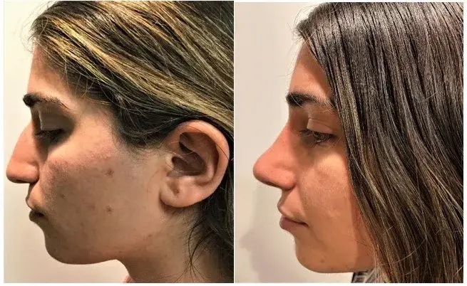 Masri Clinic for Laser and Cosmetic Surgery rhinoplasty result — Dearborn, MI