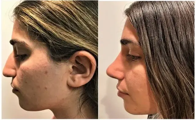 Functional Rhinoplasty result at Masri Clinic for Laser and Cosmetic Surgery in Dearborn, MI