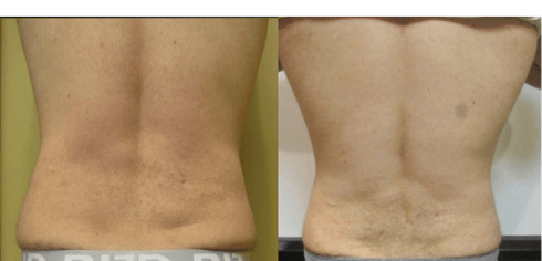 Masri Clinic for Laser and Cosmetic Surgery breast reduction result — Dearborn, MI