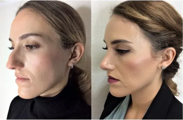 Rhinoplasty result at Masri Clinic for Laser and Cosmetic Surgery in Dearborn, MI
