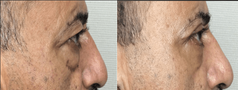 Blepharoplasty result at Masri Clinic for Laser and Cosmetic Surgery in Dearborn, MI