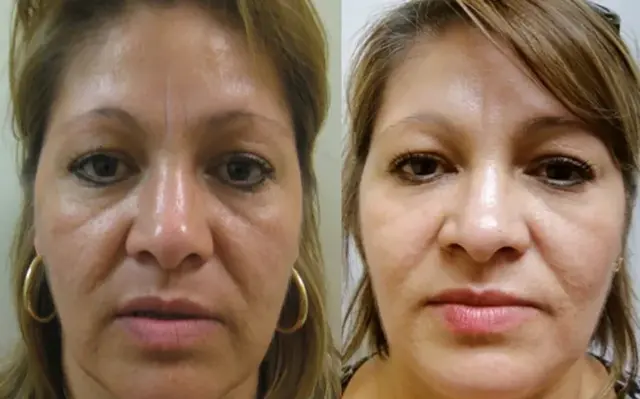 Laser Skin Resurfacing result at Masri Clinic for Laser and Cosmetic Surgery in Dearborn, MI