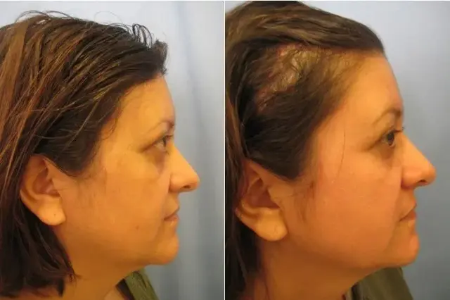 Mini Facelift result at Masri Clinic for Laser and Cosmetic Surgery in Dearborn, MI