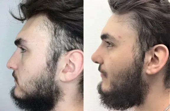 Functional Rhinoplasty result at Masri Clinic for Laser and Cosmetic Surgery in Dearborn, MI