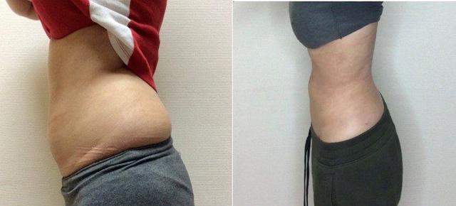 Liposuction result at Masri Clinic for Laser and Cosmetic Surgery in Dearborn, MI