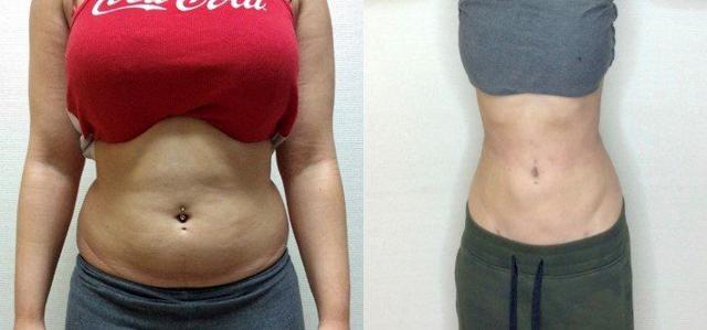 Liposuction result at Masri Clinic for Laser and Cosmetic Surgery in Dearborn, MI