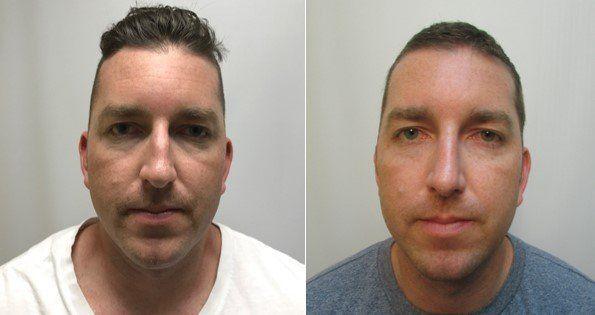 Masri Clinic for Laser and Cosmetic Surgery rhinoplasty result — Dearborn, MI