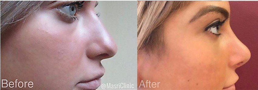 Masri Clinic for Laser and Cosmetic Surgery rhinoplasty result — Dearborn, MI