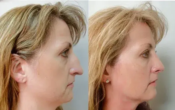 Masri Clinic for Laser and Cosmetic Surgery rhinoplasty result — Dearborn, MI