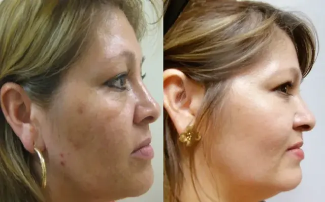 Laser Skin Resurfacing result at Masri Clinic for Laser and Cosmetic Surgery in Dearborn, MI